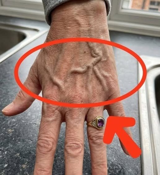 Če imate na rokah zelo vidne žile, kaj to lahko pomeni? 784251865_1651888443201863_5681734039703688160_n (1)
