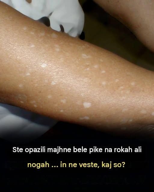 Bele lise na koži: Ali so lahko posledica pomanjkanja vitaminov? 786493005_1651887609868613_8412375418832439016_n
